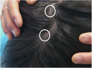 Manifestação clínica de tinha do couro cabeludo. Pequena perda de cabelo do tamanho de um feijão e “pontos pretos” espalhados na parte superior da cabeça (círculos brancos).
