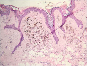Proliferação difusa de células melanocíticas de aspecto epitelioide pigmentadas na derme papilar compatível com nevo intradérmico (Hematoxilina & eosina, 100×).
