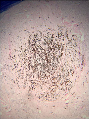 Células pigmentadas de aspecto fusiforme e dendríticas distribuídas em feixes na derme (Hematoxilina & eosina, 400×).