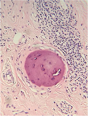Fibroplasia do colágeno, reação granulomatosa tipo corpo estranho em torno da haste de pelo livre e formações ósseas compatíveis com ossificação cutânea (Hematoxilina & eosina, 400×).