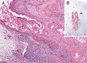 A, Infiltrado inflamatório ao redor do epitélio folicular e glândula sebácea. Descolamento bolhoso inicial na junção dermoepidérmica (Hematoxilina & eosina 40×). B, comprometimento primário do epitélio sebáceo, como demonstrado pelo exame imuno‐histoquímico específico para o vírus varicela zoster (Hematoxilina & eosina, 40×).