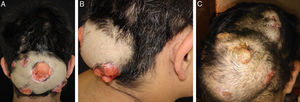 Aspecto clínico da lesão occipital de pseudomicetoma no paciente aos 14 anos (A e B) e aos 24 anos (C).