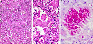 Exame histopatológico. A, Hematoxilina‐Eosina, 100×, identifica grãos circundados por processo inflamatório supurativo e reação linfo‐histiocitária. B, Hematoxilina & eosina, aumento de 200×, observa‐se a estrutura de um grão composto de hifas septadas hialinas rodeado por material eosinofílico (fenômeno de Splendore‐Hoeppli). C, Coloração de PAS, 200×, evidencia a morfologia das hifas.