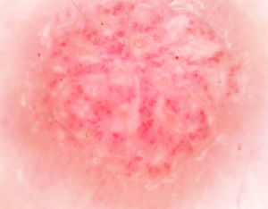 Dermatoscopia apresenta vasos glomerulares e pontilhados com arranjo em “colar de pérolas” e um colarete de escamas ao redor.
