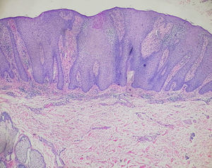 Exame histopatológico evidencia hiperplasia epidérmica psoriasiforme nitidamente demarcada, composta por queratinócitos claros e células basais com citoplasma de coloração pálida, vasos sanguíneos dilatados nas papilas dérmicas e infiltrado inflamatório perivascular misto. (Hematoxilina & eosina, 40×).