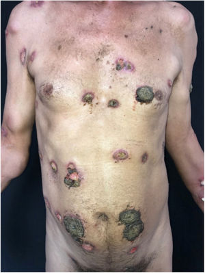 Nódulos normocrômicos e eritematosos, além de úlceras recobertas por crostas espessas e enegrecidas.