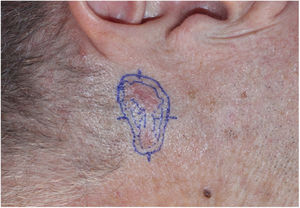 CBC. Lesão mal delimitada e não contígua que media 20×28 mm na região pré‐auricular esquerda.