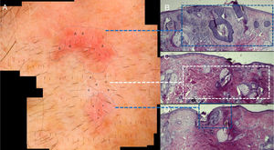 A, Imagem de DDAA de CBC. B, CBC nodular e superficial corresponde a áreas eritematosas sem estruturas (Δ) e telangectasias arboriformes (†) à dermatoscopia. C, Fibrose dérmica corresponde a áreas branco‐cicatriciais (◊), provavelmente relacionada ao tratamento tópico prévio. D, CBC superficial e fibrose dérmica correspondem a área vermelho‐leitosa (*) e telangectasias arboriformes (†).
