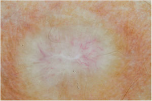 Dermatoscopia do hansenoma: de aspecto amarelado, com centro nacarado cicatricial e telangiectasias de caráter centrífugo. (Técnica de contato/imersão com álcool).