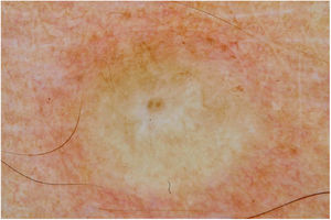 Dermatoscopia do hansenoma: presença de halo castanho claro na lesão, de aspecto amarelado, com centro nacarado cicatricial e telangiectasias de caráter centrífugo. (Técnica de contato/imersão com álcool).