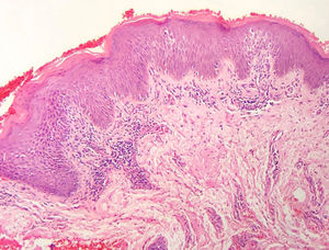 Infiltrado linfoide perivascular superficial com quantidade insuficiente de linfócitos na epiderme para caracterizar epidermotropismo. Ainda há hiperceratose, paraceratose e acantose (Hematoxilina & eosina, 100×).