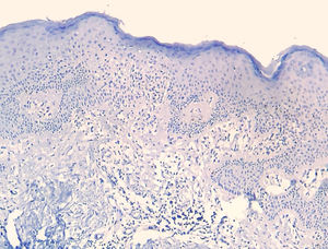 Reação de CD7 é negativa em ambos os compartimentos, caracterizando perda deste marcador T e discordância dermoepidérmica, em relação à positividade de CD3 (Imuno‐histoquímica, 40×).