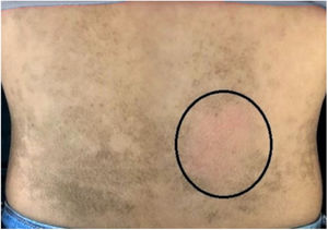 Área em destaque sem lesão, após fricção de gaze embedida com álcool 70% na pele.