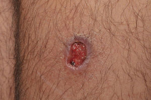 Úlcera de bordas bem delimitadas e fundo limpo na perna.