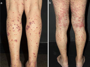 Diferentes lesões normalmente observadas em pacientes com vasculites de pequenos vasos. (a) Púrpuras, petéquias, vesículas e bolhas hemorrágicas em paciente com vasculite crioglobulinêmica, (b) Lesões urticadas, por vezes confluentes, e púrpuras nos membros inferiores muito sugestivas de urticária vasculite.