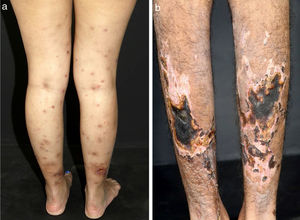 Diferentes lesões observadas em pacientes com vasculites de médios vasos: (a) Nódulos subcutâneos, úlceras e cicatrizes atróficas com bordas hiperpigmentadas em membros inferiores na arterite cutânea, (b) Extensas úlceras com áreas de necrose e cicatrizes atróficas residuais nos membros inferiores em paciente com poliangeíte microscópica.