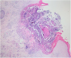 Ulceração perfurante com detritos celulares na invaginação crateriforme (Hematoxilina & eosina, 40×).