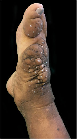 Aspecto clínico do pé e tornozelo direito, na primeira sessão de aplicação intralesional de corticosteroide. Edema não depressível associado à hiperpigmentação atinge o terço inferior do membro inferior direito, inclusive porção lateral e posterior.