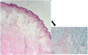 Importante espaço entre os feixes de colágeno da derme reticular superior, discreto aumento do número de fibroblastos (Hematoxilina & eosina, 200×). Depósito abundante de mucina (seta) (Alcian Blue, 400×).