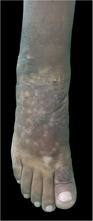 Aspecto clínico do pé e tornozelo direito após 11 meses da corticoterapia intralesional. Redução quase total dos nódulos e do edema torna a aparência semelhante ao pé contralateral.