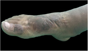 Aspecto clínico do pé e tornozelo direitos após 11 meses do tratamento com corticoterapia intralesional. Observa‐se importante redução dos nódulos e da textura cutânea.