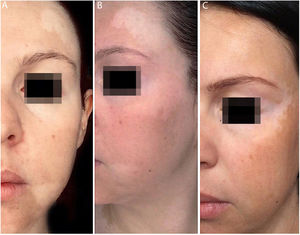 (A e B), antes do tratamento, manchas hipocrómicas por toda a face. (C), Após dois anos de tratamento, vemos completa repigmentação das manchas em fronte e perilabial, além de melhoria no restante da face.
