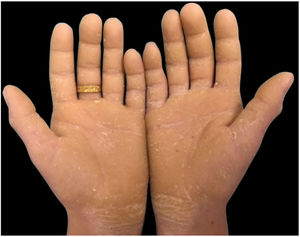 Hiperceratose em palmas.