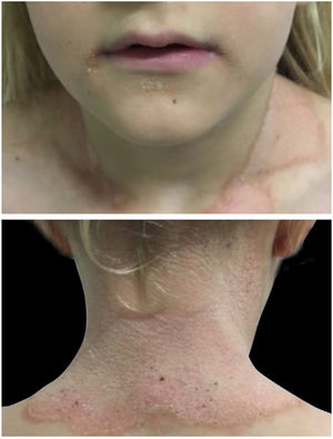Placa eritematodescamativa, hiperceratótica, com borda proeminente e geográfica em região cervical. Placas hiperceratóticas amareladas no ângulo da boca e mento.