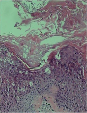 Acantose, papilomatose e hiperceratose com presença de epidermólise na camada granular (Hematoxilina & eosina, 400×).