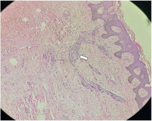 Proliferação de vasos linfáticos dilatados com paredes finas e irregulares, revestidas por células endoteliais tumefeitas na derme e com agregados linfocitários típicos; histopatologia (Hematoxilina & eosina, 10×).