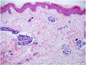 Presença de embolização linfática difusa associada a edema dérmico (Hematoxilina & eosina, 50×).