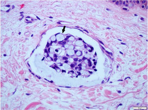 Maior detalhe mostra êmbolo linfático com células em anel de sinete (indicado pela seta) (Hematoxilina & eosina, 200×).