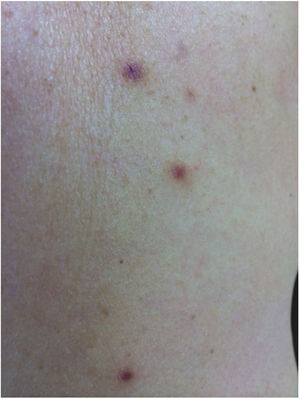 Pápulas eritêmato‐violáceas que variam de 3 a 10mm de diâmetro, dispostas no dorso.