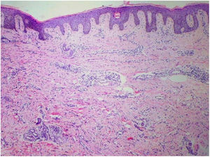 Acantose regular na epiderme e celularidade aumentada em toda a derme, bem como aumento e dilatação dos vasos sanguíneos na derme superior e média, além de infiltrado linfo‐histiocítico e espessamento das fibras de colágeno (Hematoxilina & eosina, 40×).