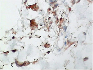 Imuno‐histoquímica. Positiva para CD68 (400×).