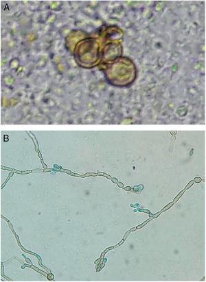 (A e B) exame direto: corpos fumagoides. Microcultivo: hifas demáceas septadas e conídios elípticos na porção superior de conidióforos simples ou pouco ramificados − características fenotípicas compatíveis com Rhinocladiella spp. (KOH‐20%, 400×; cor azul, por lactofenol, 400×).