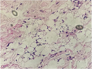 Exame histopatológico evidencia histiócitos xantomizados, sugere reação a corpo estranho (Hematoxilina & eosina, 40×).
