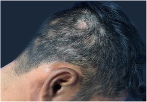 Áreas de alopecia não cicatricial no couro cabeludo.