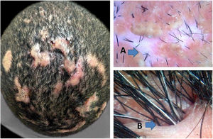 Estágio fibrótico da CD. (A) ausência de aberturas foliculares; (B)endas cutâneas com pelos emergentes.