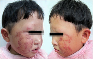 Poiquilodermia em paciente com RTS. Despigmentação, hiperpigmentação, atrofia puntiforme, telangiectasia e perda de sobrancelhas observadas bilateralmente na face.
