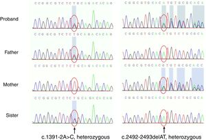 Duas novas variantes heterozigóticas no gene RECQL4 confirmadas por sequenciamento genético. Uma estava no local do splicing, c.1391‐2A> C, proveniente do pai e também observada na irmã. A outra era uma mutação de exclusão, c.2492_2493delAT (p.His831Argfs), proveniente da mãe.