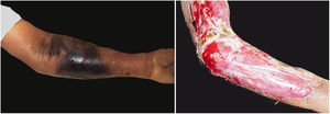 Fasciíte necrosante pós‐manipulação de miíase furunculoide. (A) Presença de edema, discreto eritema e principalmente extensa área de necrose. (B) Produto de desbridamento onde ainda se observam pontos de necrose.
