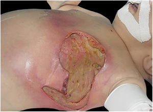 Fasciíte necrosante em lactente após tentativa de expressão de leite gotejante do mamilo. Área desbridada até plano muscular com remoção da fáscia. Presença de atividade infecciosa em parte do tórax.