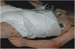 Ectima gangrenoso por Pseudomonas aeruginosa: múltiplas lesões em diferentes estádios de evolução em paciente em quimioterapia por doença mieloproliferativa.