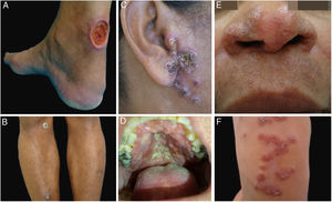 Exemplos clínicos dos pacientes com lesões clínicas cuja pesquisa PCR‐HRM determinou a espécie de Leishmania sp. (A), paciente 11 (L. infantum chagasi); (B), paciente 13 (L. amazonensis + L. infantum chagasi); (C), Paciente 14 (L. amazonensis + L. infantum chagasi); (D), paciente 7 (L. brasiliensis); (E), paciente 3 (L. amazonensis); (F), paciente 5 (L. amazonensis).