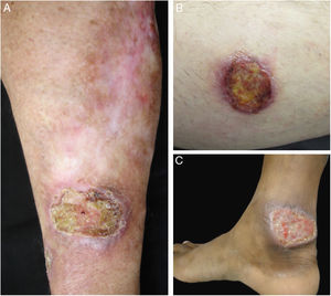 Exemplos dos pacientes com lesões clínicas cujas pesquisas PCR‐HRM não detectaram Leishmania sp. (A), paciente 17, com úlcera em membro superior; (B), paciente 21, com úlcera em membro inferior cuja biópsia evidenciou presença de amastigotas no tecido; (C), paciente 21 com úlcera em membro inferior.
