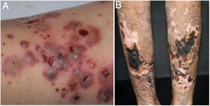 Vasculites associadas ao ANCA: (A) granulomatose eosinofílica com poliangeíte manifesta‐se como púrpuras palpáveis e petéquias, ambas manifestações comuns e inespecíficas desse grupo de vasculites; (B) um paciente portador de poliangeíte microscópica com úlceras necróticas extensas bilateralmente nos membros inferiores.