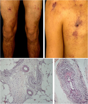 Arterite cutânea com púrpura retiforme em áreas de livedo racemoso prévio e respectivo exame histopatológico, evidencia no tecido subcutâneo uma vasculite verdadeira.