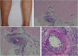 Arterite macular linfocítica (arterite trombofílica linfocítica) mostra lesões tipo livedo sem ulceração nas pernas e respectivo exame histopatológico demonstra na junção dermo‐hipodérmica um vaso arterial circundado por infiltrado linfocitário e com anel de fibrina na camada íntima.