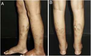 Vasculite nodular: as regiões posterolaterais das pernas estão acometidas por nódulos e placas de coloração violácea. Um curativo foi colocado no local onde uma biópsia de pele havia sido colhida alguns dias antes.